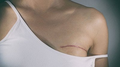Eine Frau in weißem Hemdchen mit Operationsnarbe an der Brust