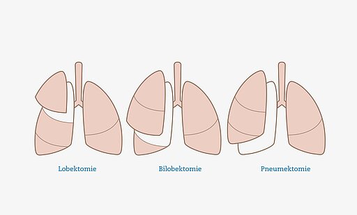 Infografik zu Operationsmethoden bei Lungenkrebs
