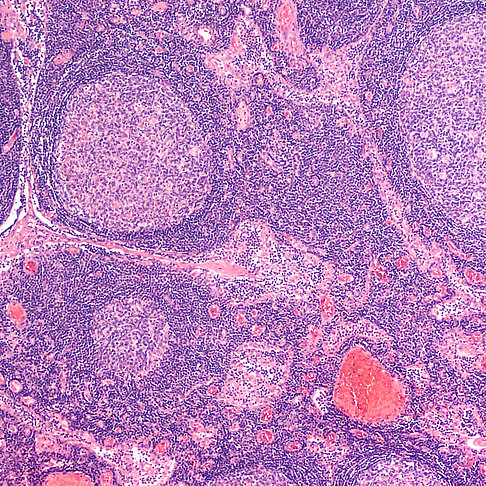Mikroskopisches Bild aus einer Lymphknoten-Biopsie