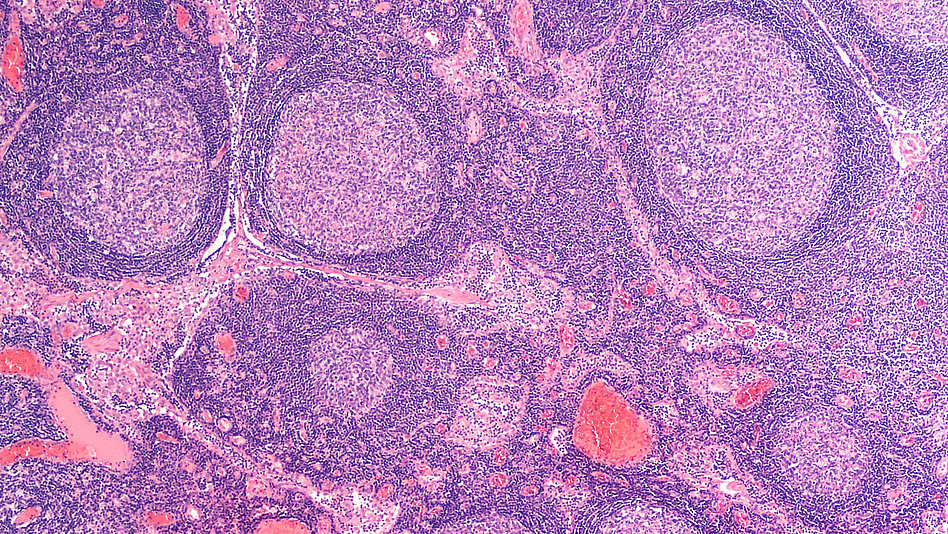 Mikroskopisches Bild aus einer Lymphknoten-Biopsie