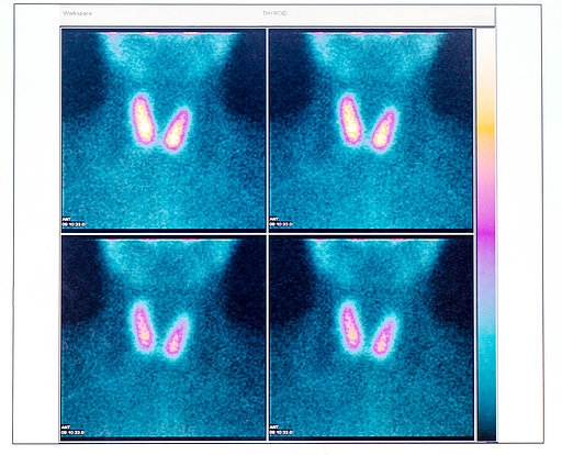 Szintigraphie-Bild einer Schilddrüse, mit roten und blauen Gebieten