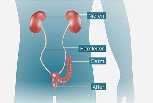 Anatomische Darstellung einer Harnleiter-Darmimplantation inklusive ihrem Anschluss an Harnleiter und Nieren