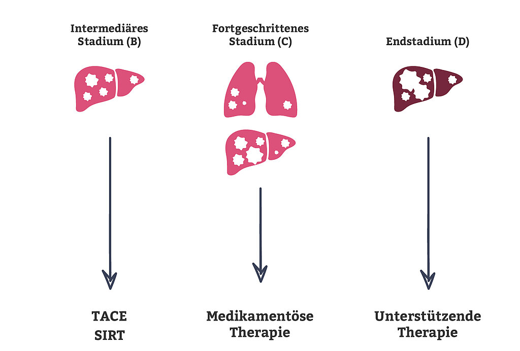 Leberkrebs Diagnose und Therapie I Das K Wort