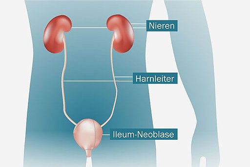 Anatomische Darstellung einer Neoblase inklusive ihrem Anschluss an Harnleiter und Nieren