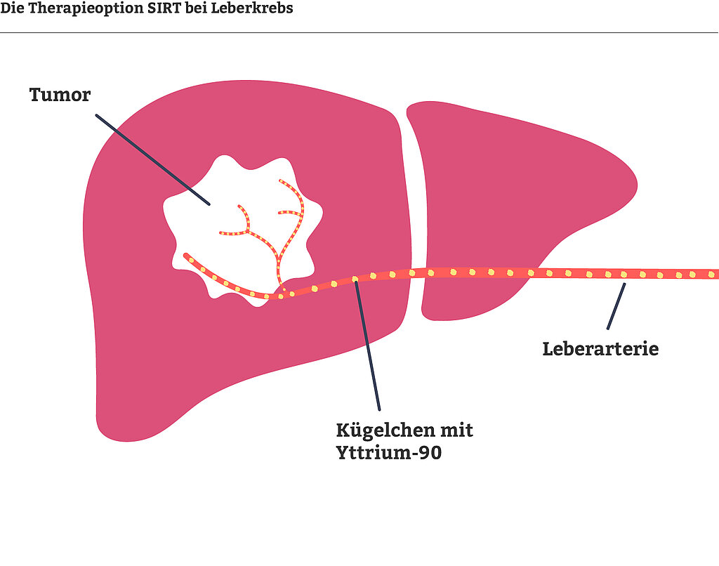 Leberkrebs Diagnose und Therapie I Das K Wort