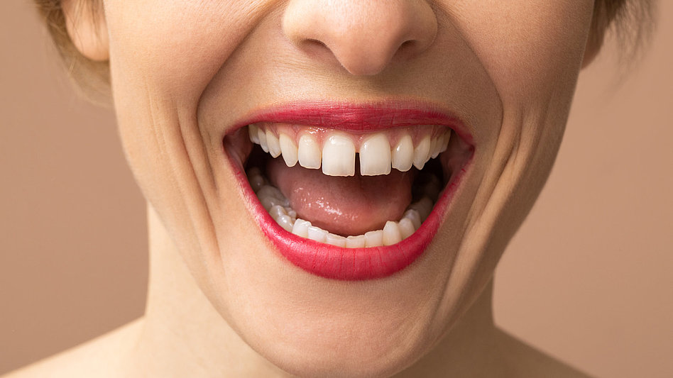 Nahaufnahme eines lachenden Mundes mit strahlend weißen Zähnen