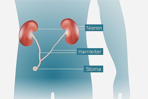 Anatomische Darstellung einer Harnleiter-Haut-Fistel inklusive ihrem Anschluss an Harnleiter und Nieren