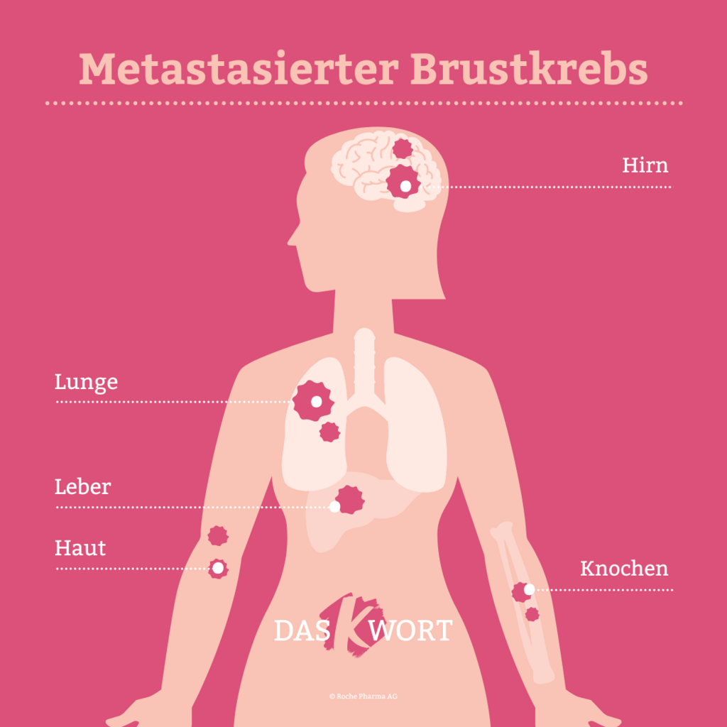 Brustkrebs mit Metastasen Diagnose und Therapie