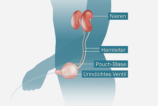 Anatomische Darstellung einer Pouch-Blase inklusive ihrem Anschluss an Harnleiter und Nieren