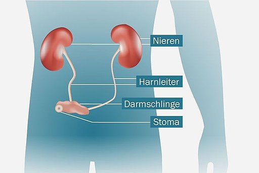 Anatomische Darstellung einer Conduit-Lösung inklusive ihrem Anschluss an Harnleiter und Nieren