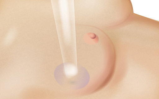 Schematische Darstellung der Strahlentherapie an einer weiblichen Brust