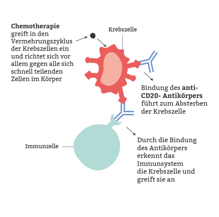 Immunchemotherapie: Die Chemotherapie hemmt die Krebszellen und die Antikörper aktivieren das Immunsystem