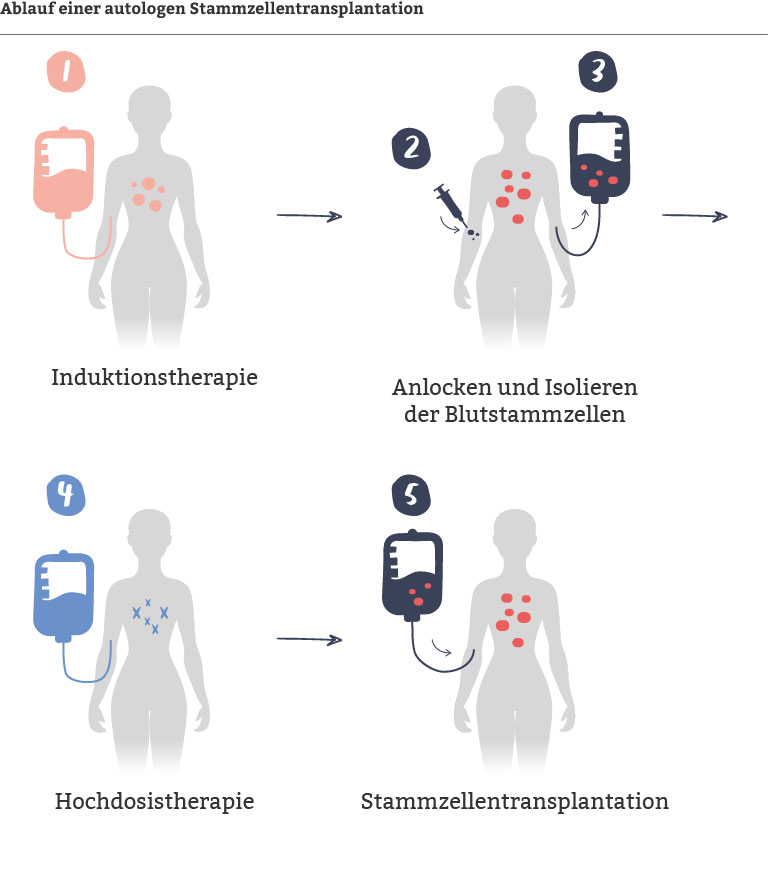 Eine Abbildung zur autologen Stammzelltherapie bei einem DLBCL Rückfall in verschiedenen Schritten