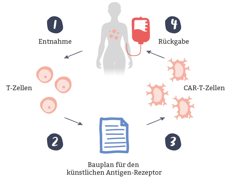 Infografik illustriert die CAR-T-Zell-Therapie